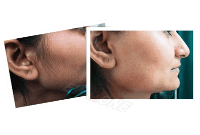Dubkart Cordless Electric Facial Epilator Threading Hair Remover
